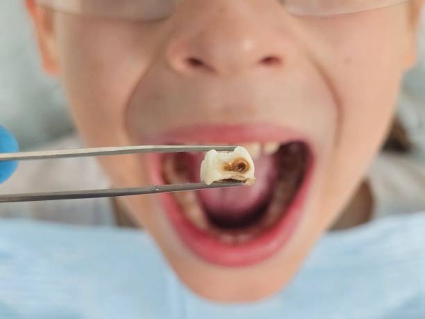 Best Emergency Dental Care for Broken or Chipped Teeth in Abbotsford, WI
